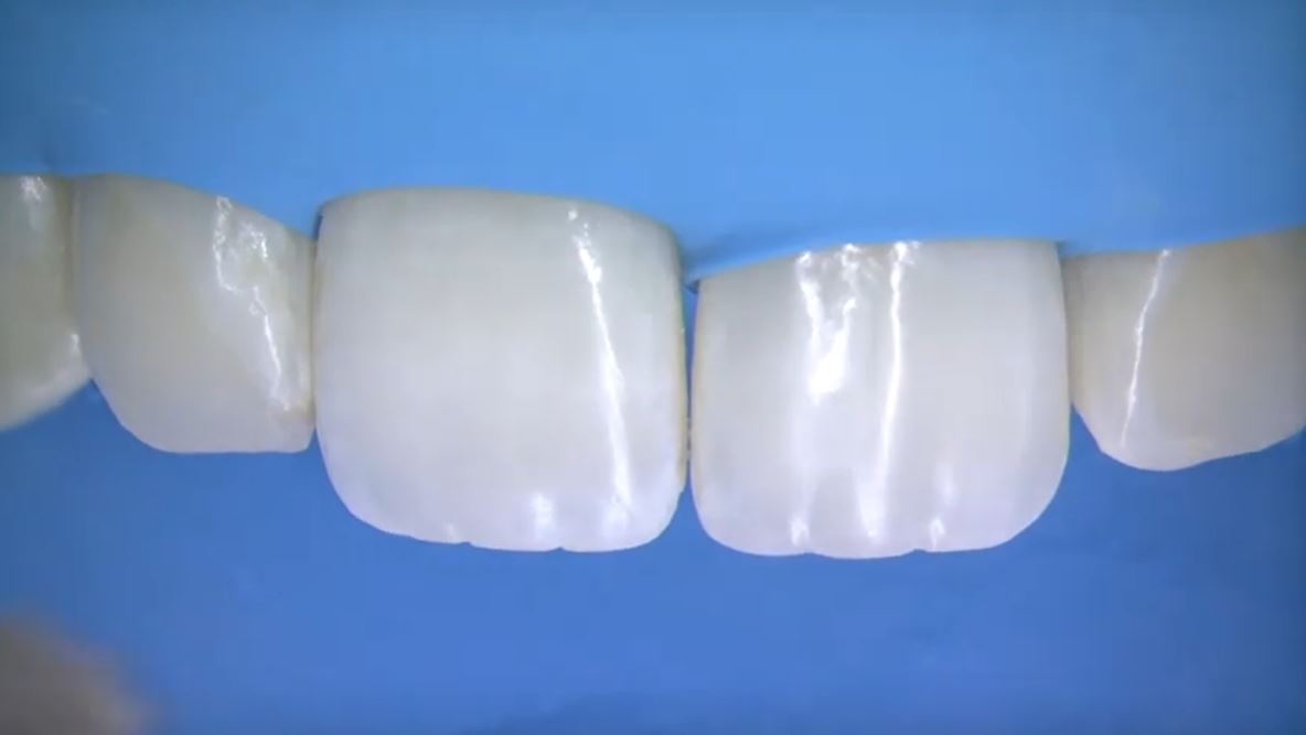 Dr Vanini no-prep incisal edge restoration