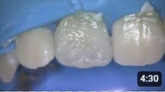 Dr. Vanini direct aesthetic restoration with HRi
