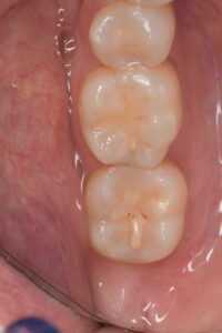 Worn and infiltrated restorations requiring replacement