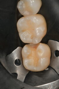 The cavities