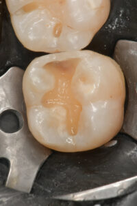 Interproximal wall restored with Ena HRi Bio Function BF2 enamel