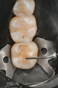 A layer of Ena HRi Flow UD4 is placed as cavity base